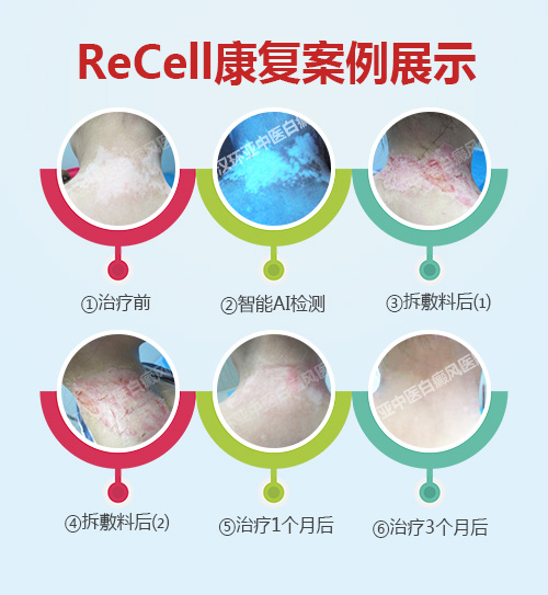 北京协和专家来院开展ReCell手术暨春季手术精准化评估