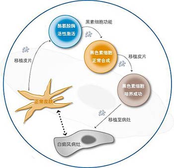 黑色素细胞培植术