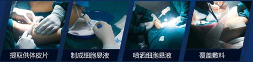 ReCell细胞再生术