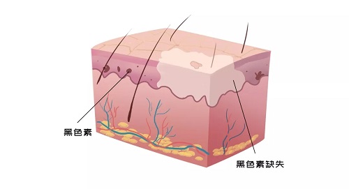 白癜风重点实验室大型公益行动,招募详情发布!